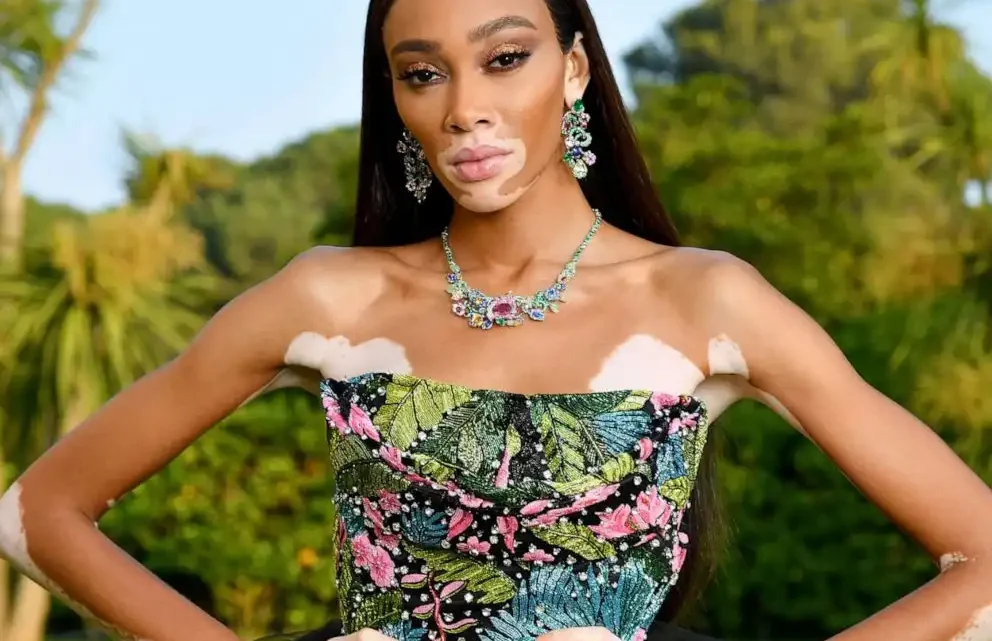 Winnie Harlow Biography: Husband, Net Worth, Daughter, Age, Height, Boyfriend, Kids, Skin Disease, Parents, Siblings