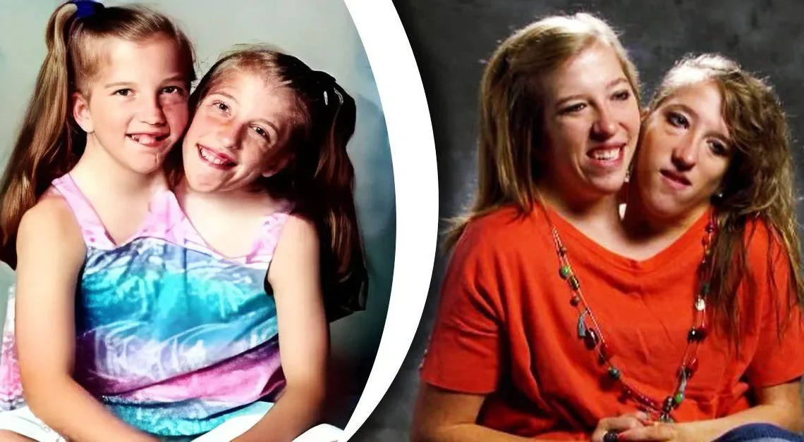 Abby Hensel Biography: Height, Age, Twins, Net Worth, Husband, Siblings, Parents, Children, Books