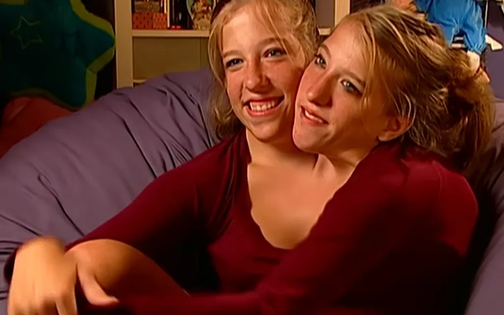 Meet the Conjoined twins Brittany and Abby Hensel