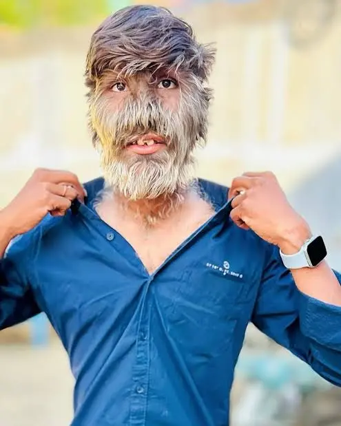 Lalit Patidar Biography: Age, Parents, Guinness World Record, Net Worth, Hypertrichosis, Career Lalit Patidar Biography: Age, Parents, Guinness World Record, Net Worth, Hypertrichosis, Career